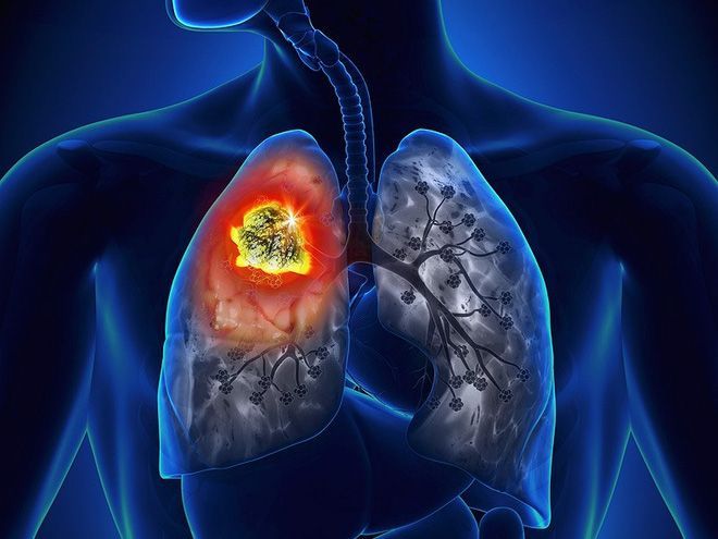Bốn nhóm người cần đặc biệt cảnh giác với ung thư phổi