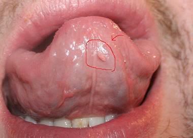 Các triệu chứng bệnh sùi mào gà ở miệng thường gặp