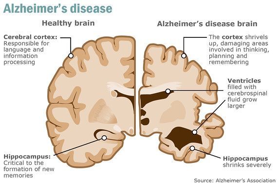 Sử dụng thuốc điều trị vi rút herpes để làm chậm bệnh Alzheimer