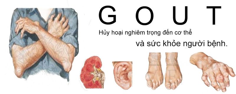 Bệnh Gout biến chứng nặng đang gia tăng nhanh