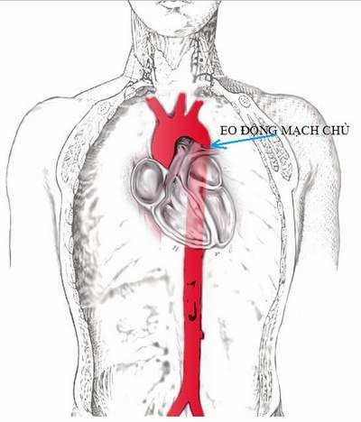 Các biến chứng và cách điều trị bệnh bóc tách động mạch chủ