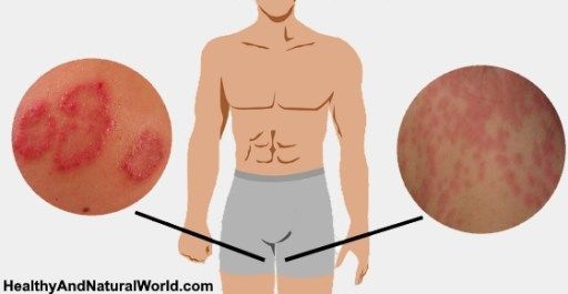 Nấm bẹn: Nguyên nhân, triệu chứng và cách điều trị bệnh