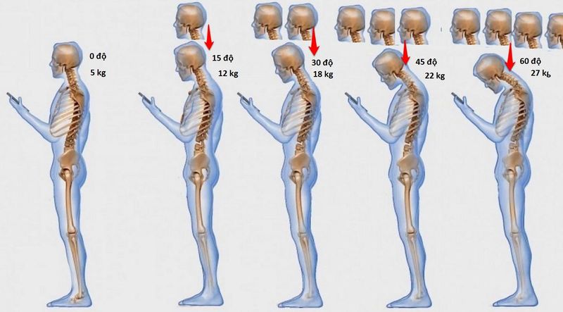 [Cảnh báo] Hậu quả khó lường khi dùng điện thoại sai tư thế