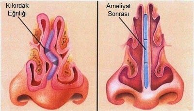 Dấu hiệu nhận biết khi bị vẹo vách ngăn mũi