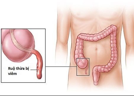 Nhận biết dấu hiệu bệnh đau ruột thừa