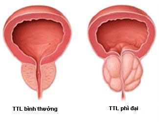 Ung thư tuyến tiền liệt – Triệu chứng dễ thấy & Cách điều trị