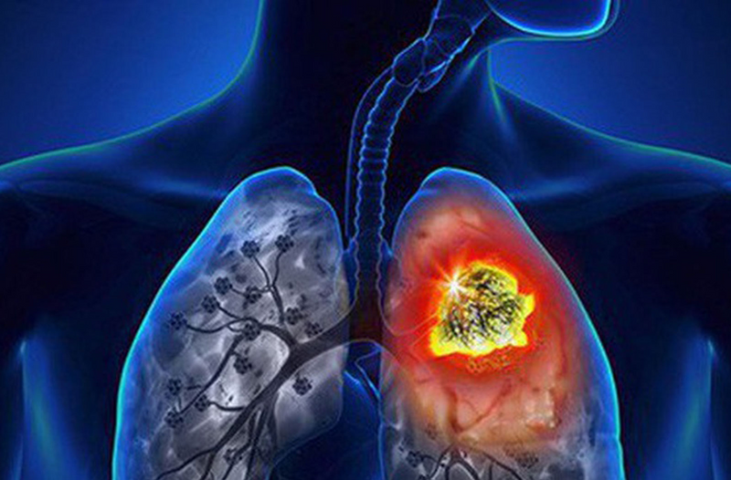 Thuốc lá có thể gây ung thư phổi như thế nào?