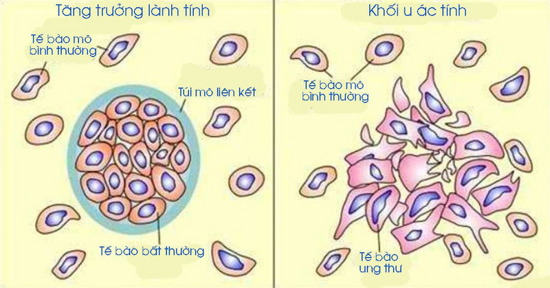 So sánh u lành tính và u ác tính