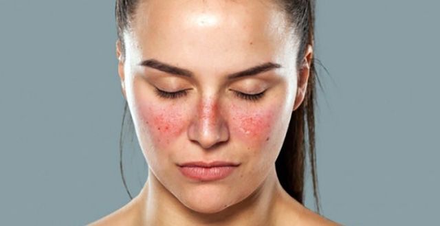 Bệnh lupus ban đỏ nguy hiểm thế nào?