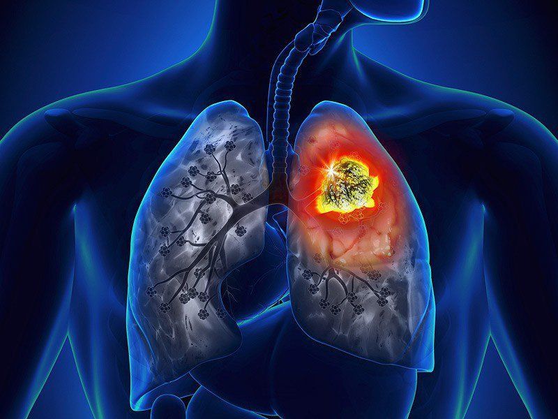 Ung thư phổi và những điều bạn chưa biết
