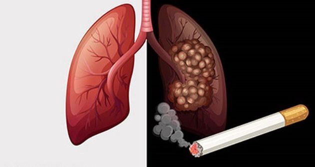 Lá phổi đen kịt sau khi hút 20 điếu thuốc lá