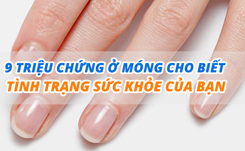 9 triệu chứng ở móng cho biết tình trạng sức khỏe của bạn