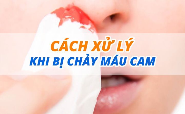 Cách sơ cứu khi chảy máu cam