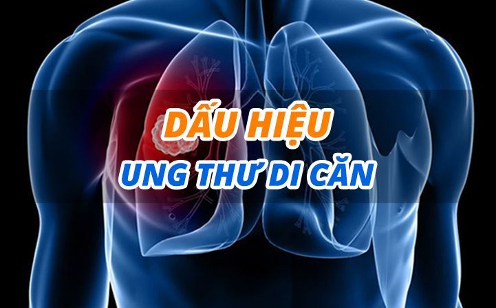 Các dấu hiệu của ung thư di căn