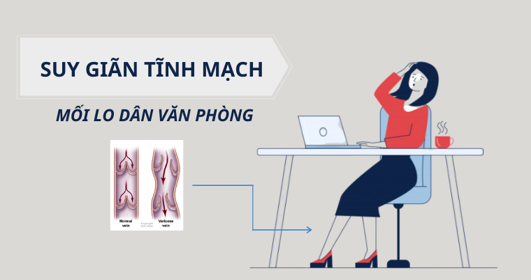 Suy giãn tĩnh mạch chân – mối lo văn phòng