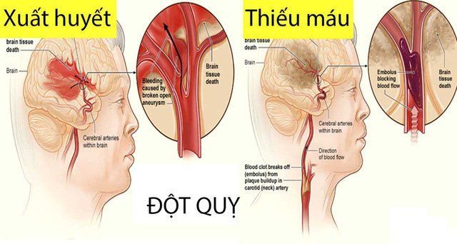 Những điều mà bạn đang hiểu sai về bệnh đột quỵ