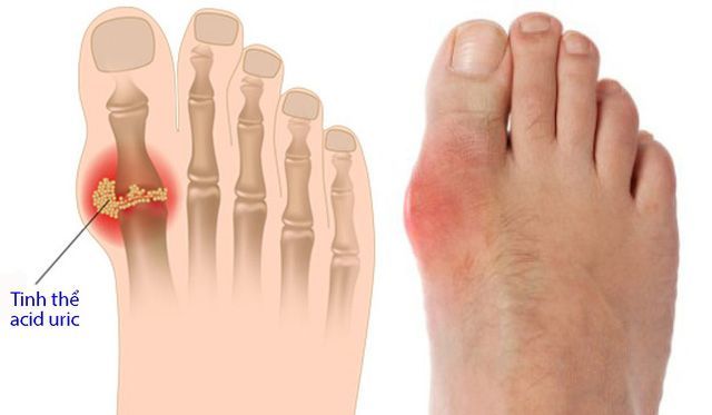 Tăng acid uric trong máu: Nguyên nhân của bệnh gout và các biến chứng nguy hiểm