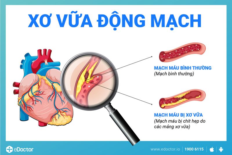 Những người dễ bị xơ vữa động mạch là ai?