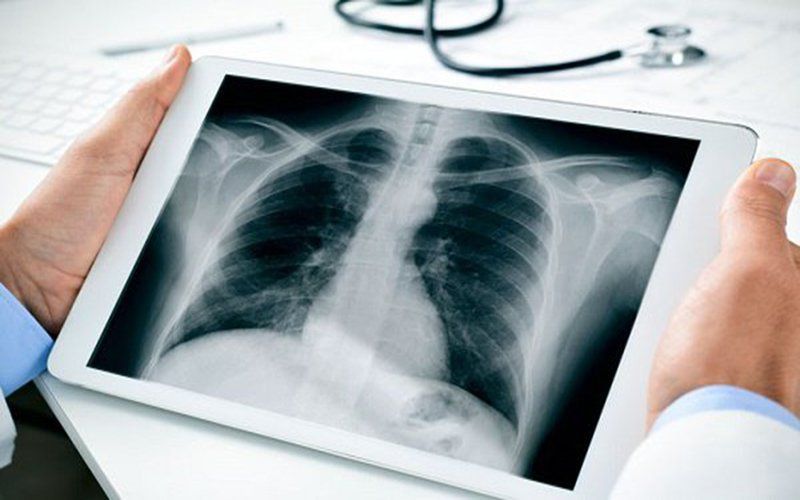 ﻿Chụp X quang phổi có thể chẩn đoán được những bệnh gì?