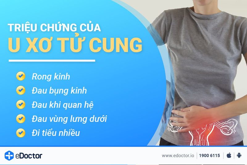 U xơ tử cung: Trường hợp nào cần phải tiến hành phẫu thuật?