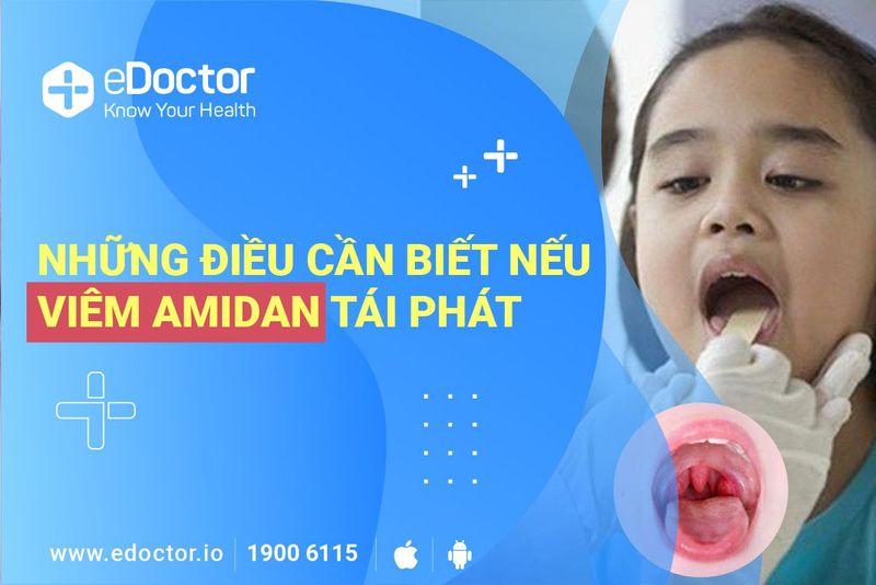 Những lưu ý phòng ngừa viêm Amidan tái phát