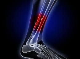 Gãy xương cẳng chân mất bao lâu để hồi phục?