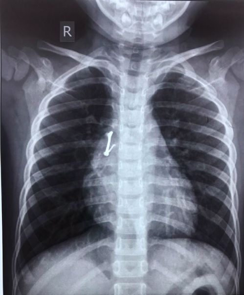 Bản tin sức khỏe 26/04/2021 - Phục hồi "bản lĩnh đàn ông" cho người bệnh mất dương vật do bỏng điện cao thế