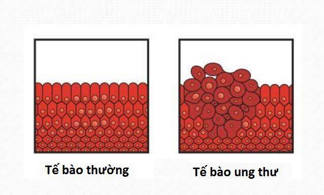 Tầm soát ung thư và những điều cần biết