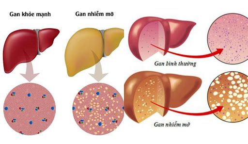 Gan nhiễm mỡ không chỉ do chất béo: Đây là 7 “kẻ thù” bạn cần cảnh giác  