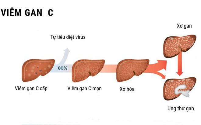 Viêm gan C lây qua đường nào? phòng ngừa bệnh như thế nào ?