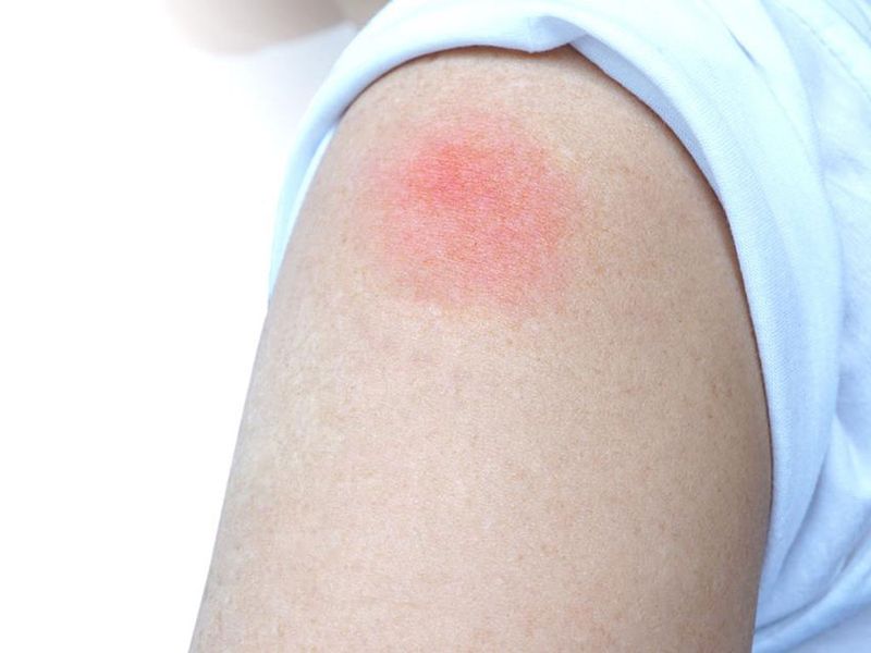 Phản ứng “cánh tay COVID-19” sau tiêm vaccine có đáng ngại?