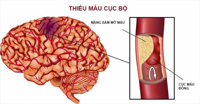 Cách xử trí các ca bệnh đột quỵ cấp liên quan tới COVID-19