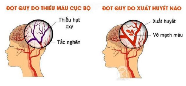 Cách xử trí các ca bệnh đột quỵ cấp liên quan tới COVID-19