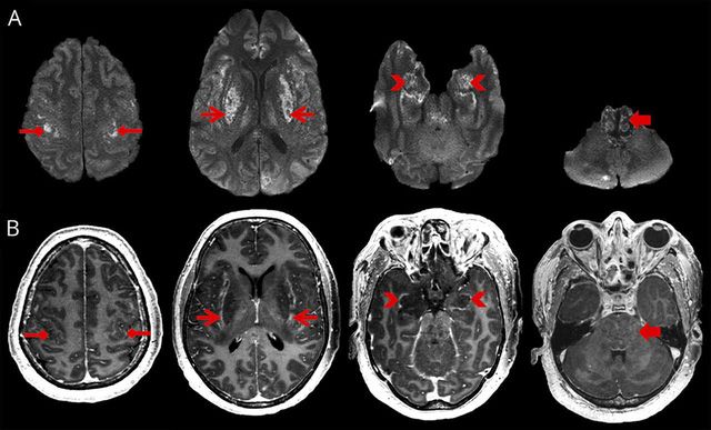 Cách xử trí các ca bệnh đột quỵ cấp liên quan tới COVID-19