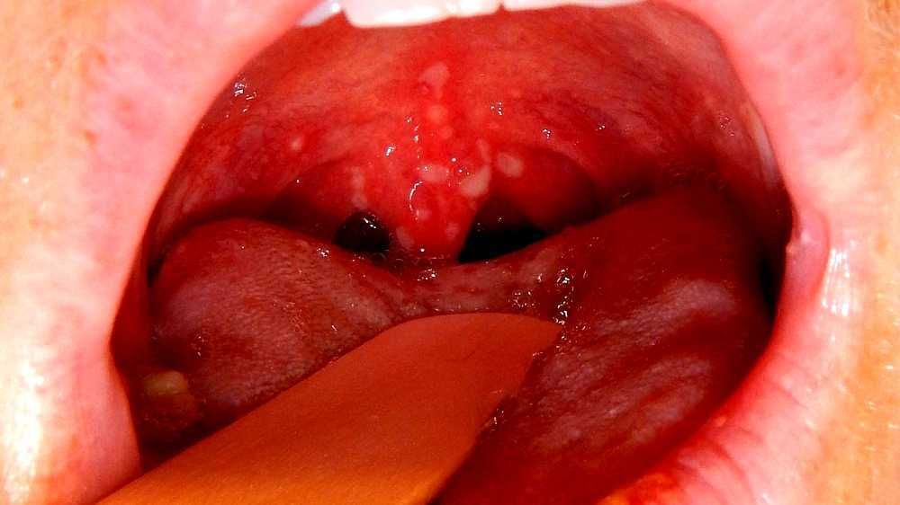 Viêm họng: Triệu chứng và cách phòng ngừa, điều trị tại nhà