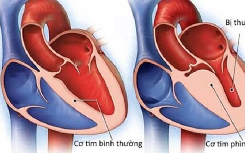 Viêm cơ tim sau tiêm vaccine COVID-19 có đáng ngại?