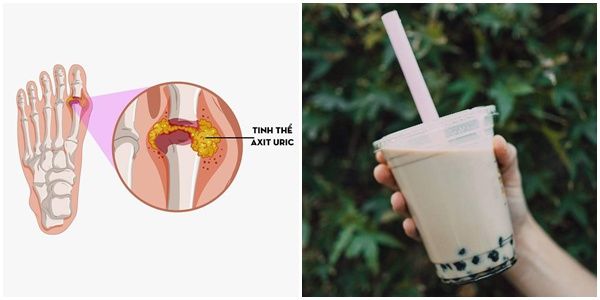 Uống trà sữa trân châu mỗi ngày dẫn đến nguy cơ mắc bệnh gout cao