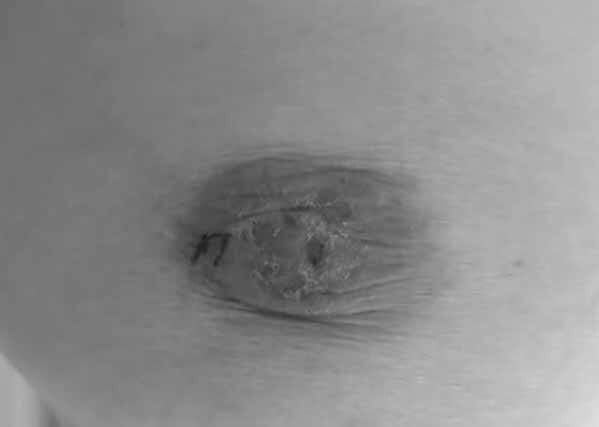 Loại ung thư vú thể hiếm dễ chẩn đoán nhầm bệnh da liễu