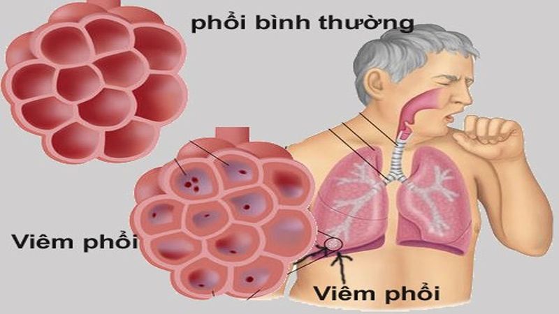 Điểm danh 7 ngành nghề khiến bạn dễ mắc các bệnh về đường hô hấp