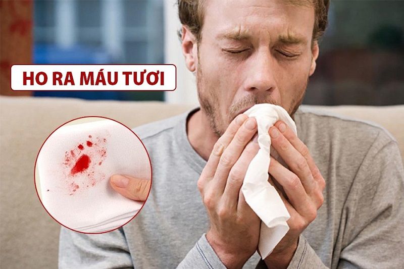 Triệu chứng lao phổi và những điều cần biết về bệnh lý