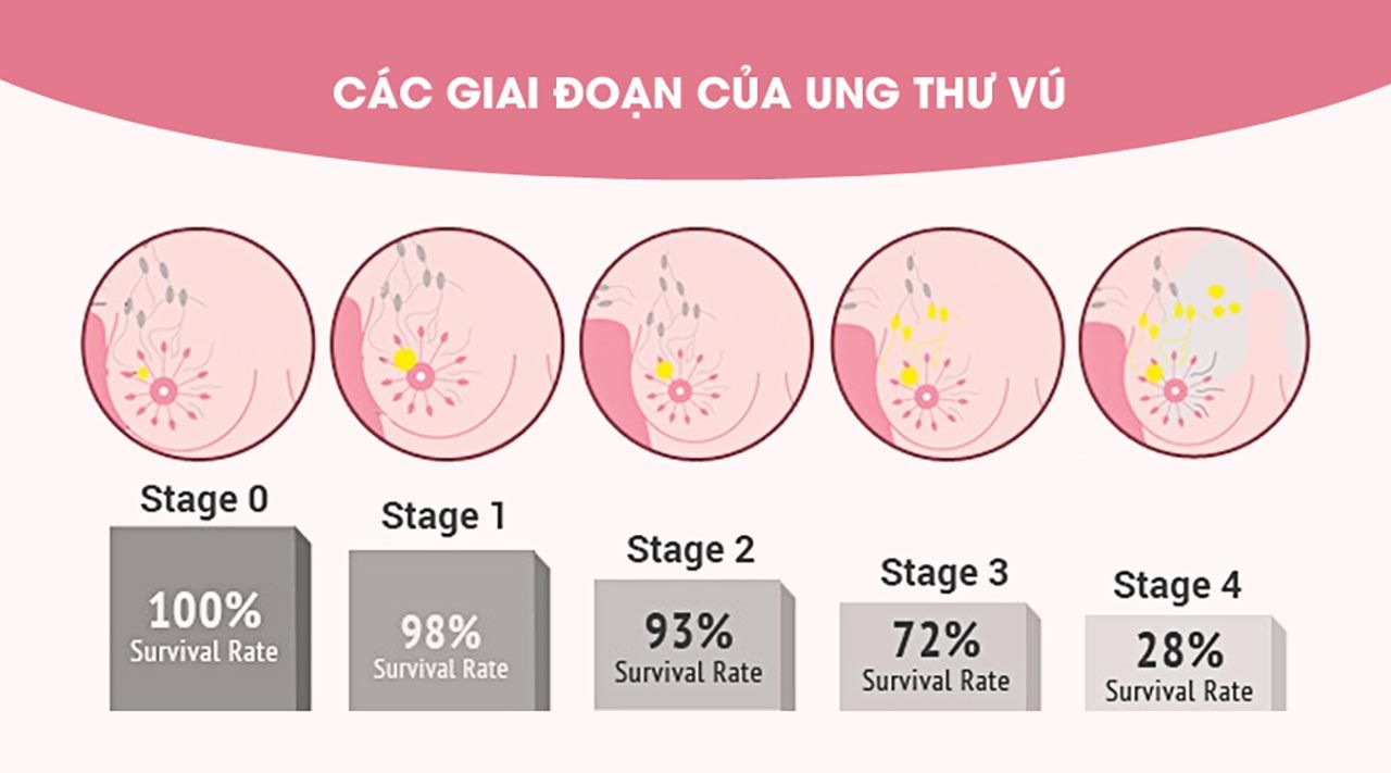 Lỡ 'thời gian vàng' trị ung thư vú do chậm đến viện