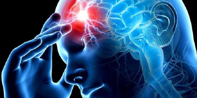 Đau đầu kéo dài, cảnh giác dị dạng mạch máu não