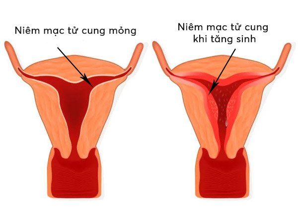 Niêm mạc tử cung mỏng, khó có con, nên ăn gì để cải thiện? 