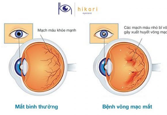 Mắt nhìn 'chớp sáng, ruồi bay' - coi chừng bong võng mạc