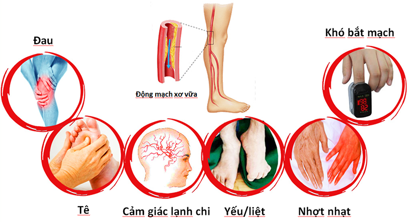 Mối nguy hiểm của bệnh tim mạch và các triệu chứng cảnh cáo của bệnh không nên bỏ qua