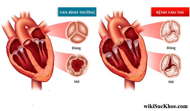 Mối nguy hiểm của bệnh tim mạch và các triệu chứng cảnh cáo của bệnh không nên bỏ qua