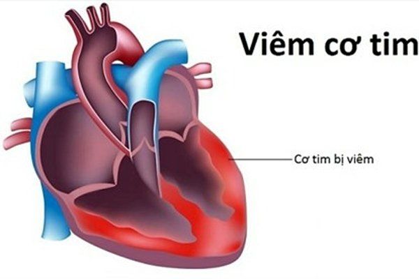 Mối nguy hiểm của bệnh tim mạch và các triệu chứng cảnh cáo của bệnh không nên bỏ qua