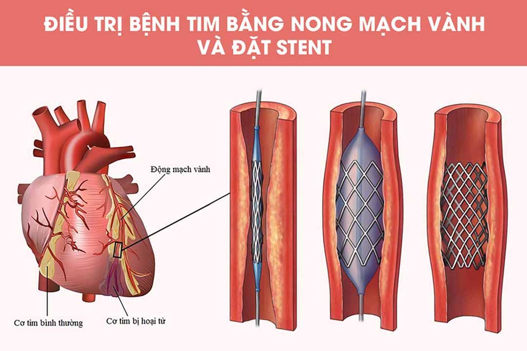 [CẢNH BÁO] Top 7 bệnh tim mạch ở việt nam có tỷ lệ mắc cao nhất 
