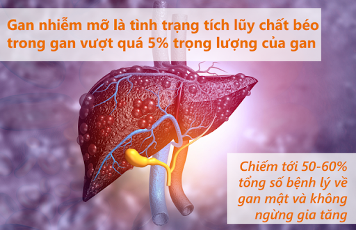 Gan nhiễm mỡ - căn bệnh thầm lặng ai cũng có thể mắc, phải tránh làm sao?