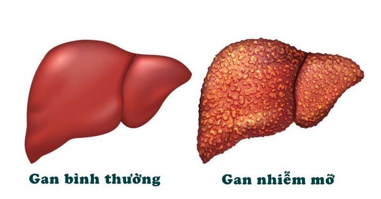 Gan nhiễm mỡ - căn bệnh thầm lặng ai cũng có thể mắc, phải tránh làm sao?